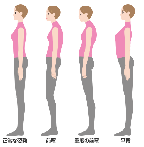 妊娠時の姿勢は下記画像の重度の前弯と同じ姿勢になります。正しい姿勢に戻すケアが必要です